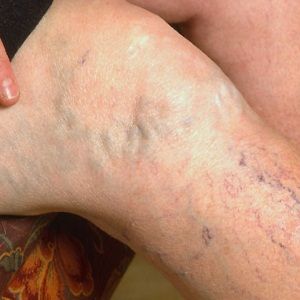 spider veins