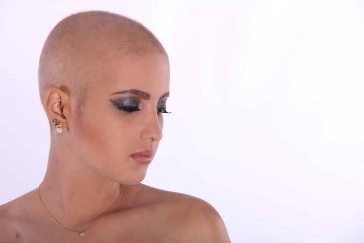 alopecija