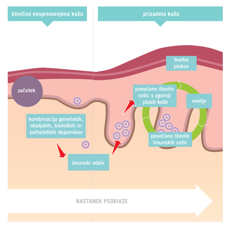 slika_1_nastanek_psoriaze