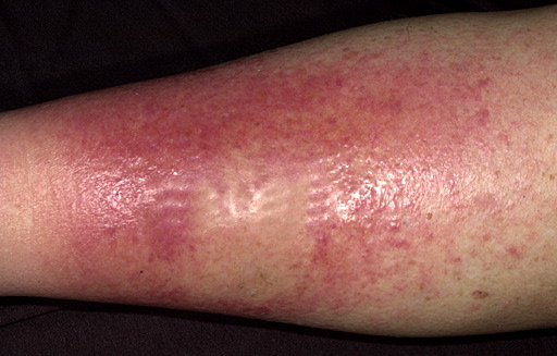 09cellulitis0811