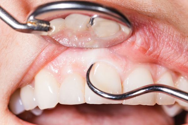 gum_disease