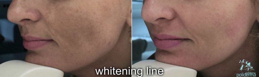 Poliderma White Skin Kaliterna obraz madež