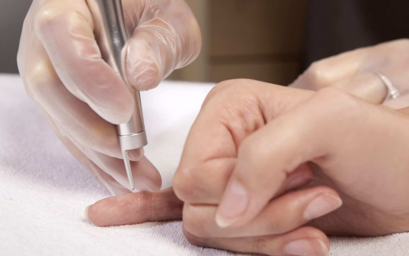 Bradavice lasersko estetko odstranjevanje Estetika Milosević