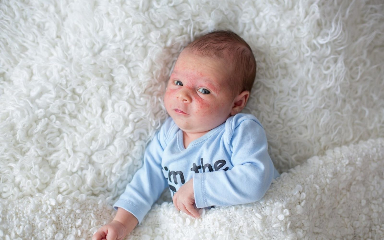 dojenček z atopijskim dermatitisom v postelji