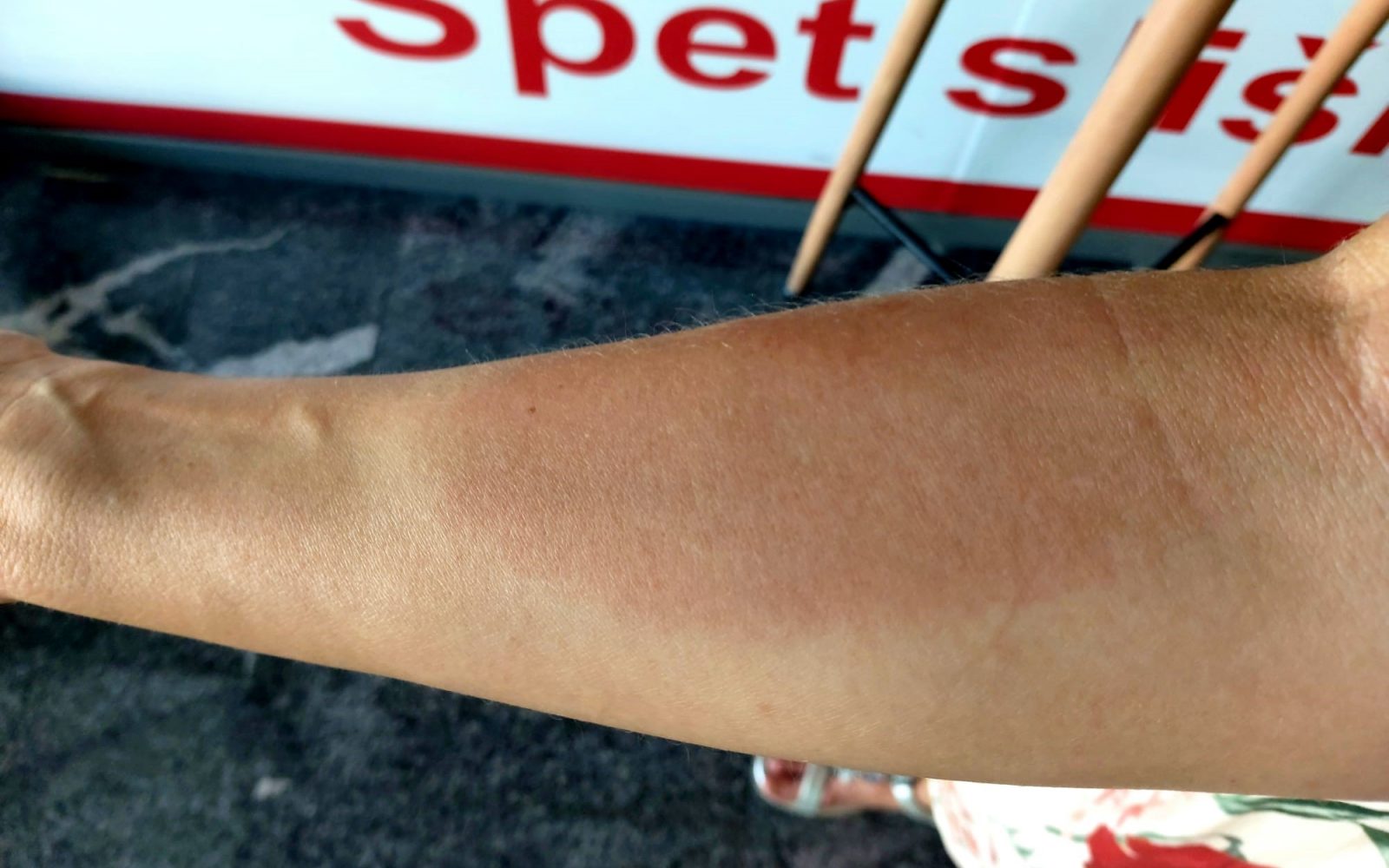 Alergijska reakcija po piku ose