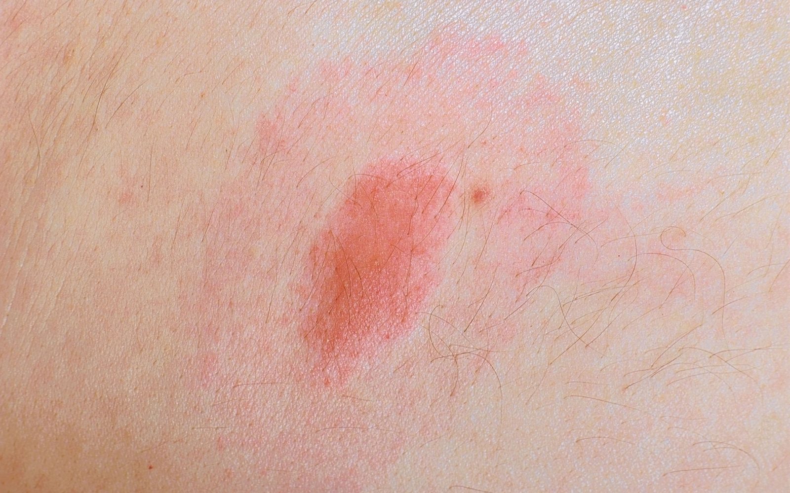 erythema migrans