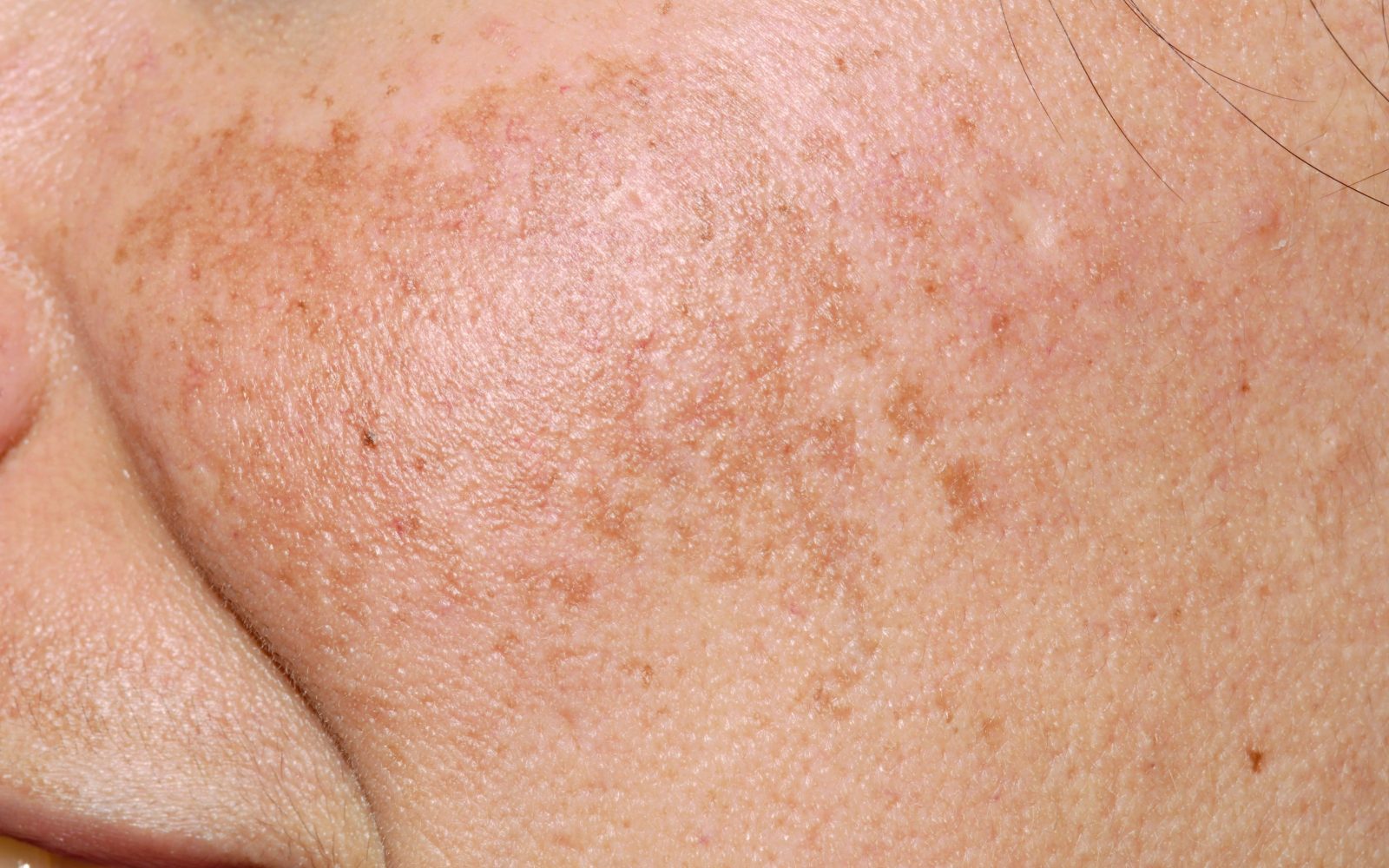 Melasma na licu