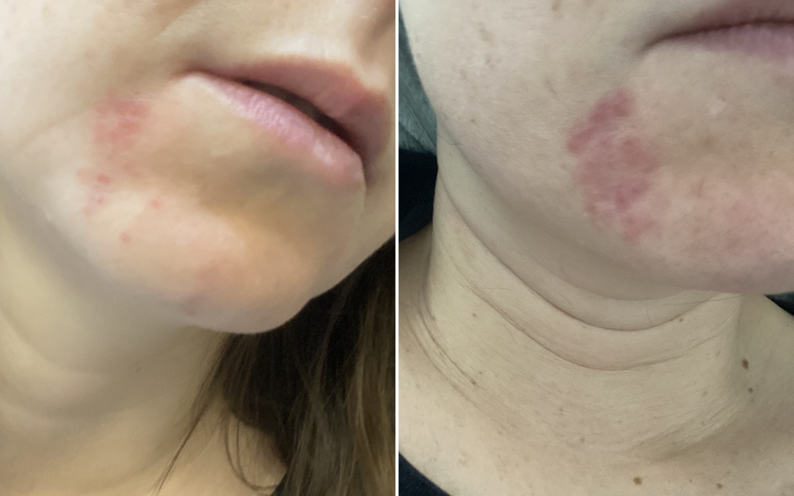 peroralni dermatitis