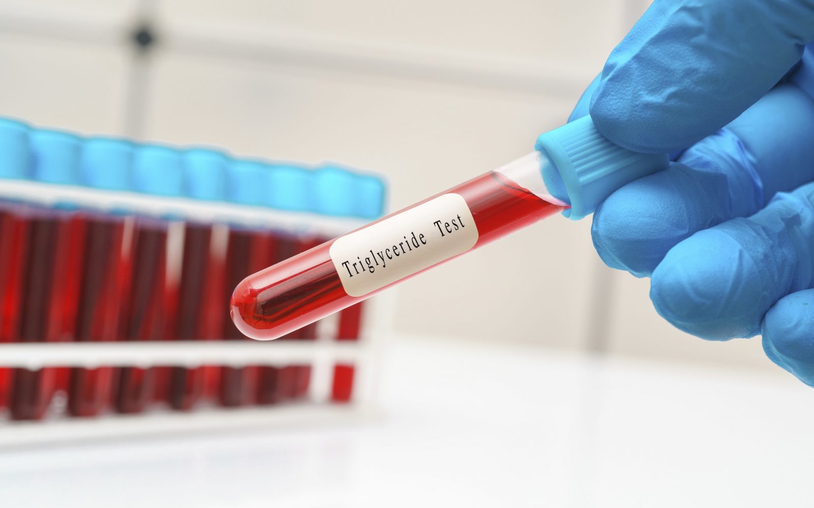 Trigliceridi in zdravje: Kaj pomenijo rezultati preiskav