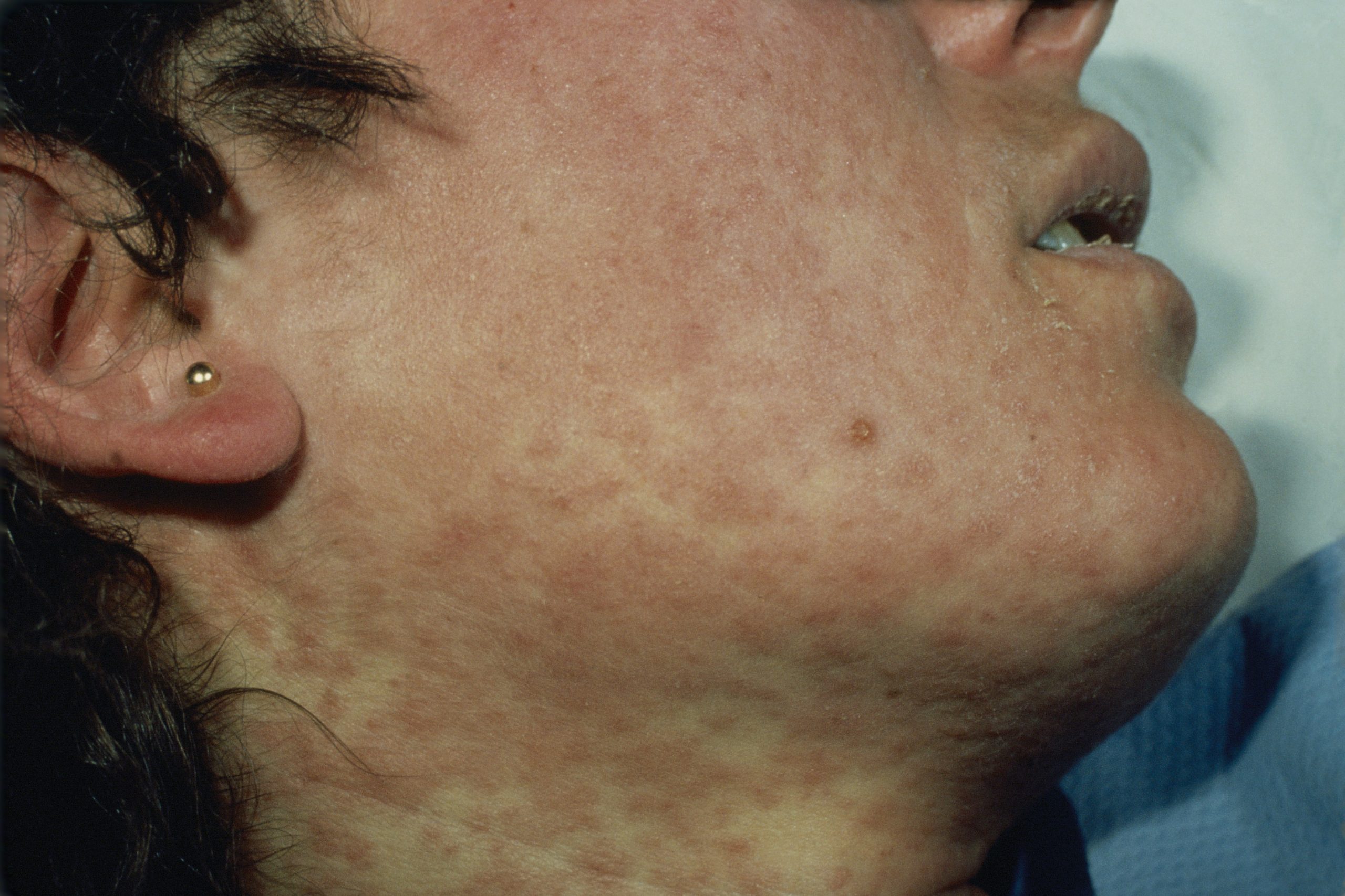 Izpuščaj pri ošpicah (measles)