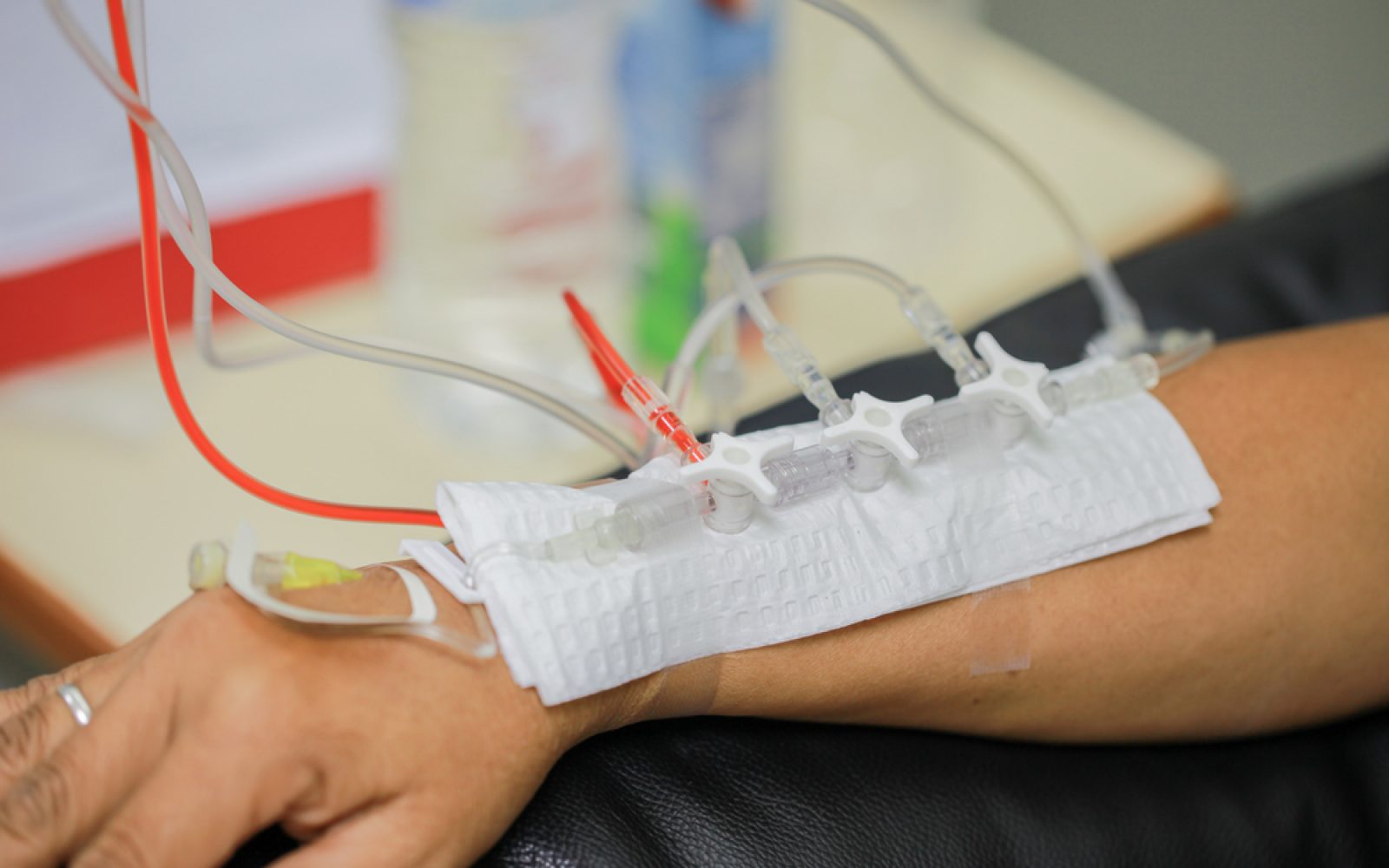 Fotografija prikazuje roko pacienta, ki prejema intravenozno (IV) terapijo. Na roki so vidne infuzijske cevke in kateter, ki omogočajo dostavo zdravil ali tekočin neposredno v krvni obtok. Slika poudarja pomembnost IV terapije pri zdravljenju in medicinski oskrbi bolnikov v bolnišnici ali kliniki. Idealna je za članke o zdravstveni oskrbi, zdravljenju bolezni, bolnišnični negi in medicinskih postopkih.