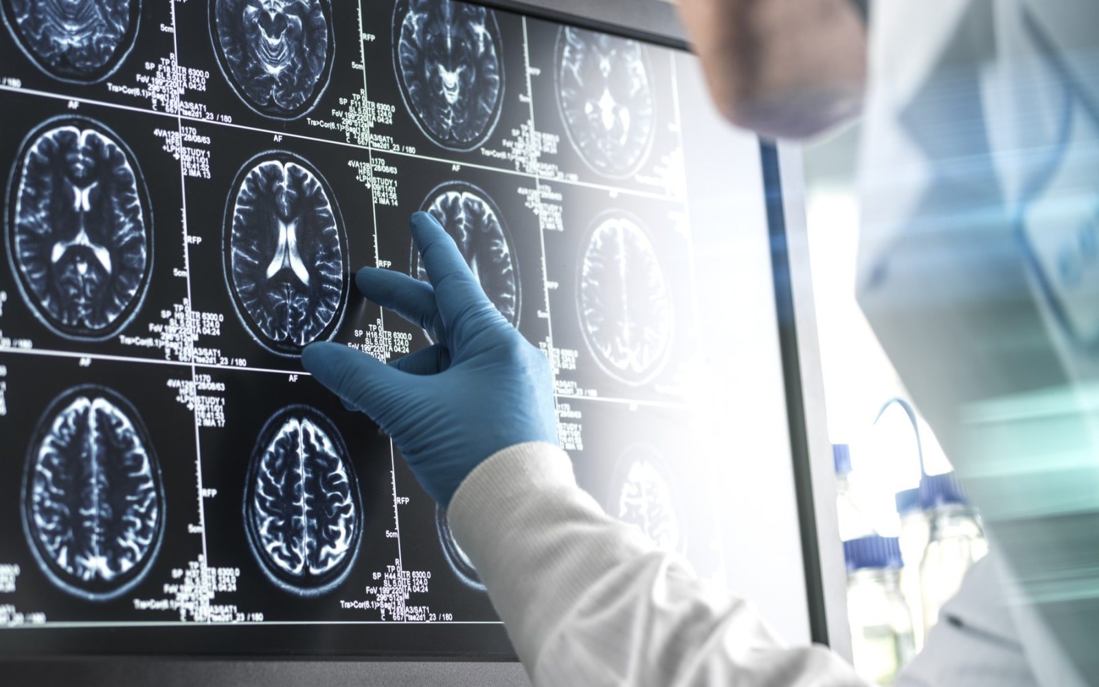 Zdravstveni delavec z rokavicami pregleduje možganske skene (MRI) na zaslonu, pri čemer s prstom kaže na določeno področje možganov. Slika prikazuje medicinsko diagnostiko, nevrološke preiskave in analizo možganskih slik, kar je pomembno pri odkrivanju in zdravljenju različnih možganskih bolezni in motenj.
