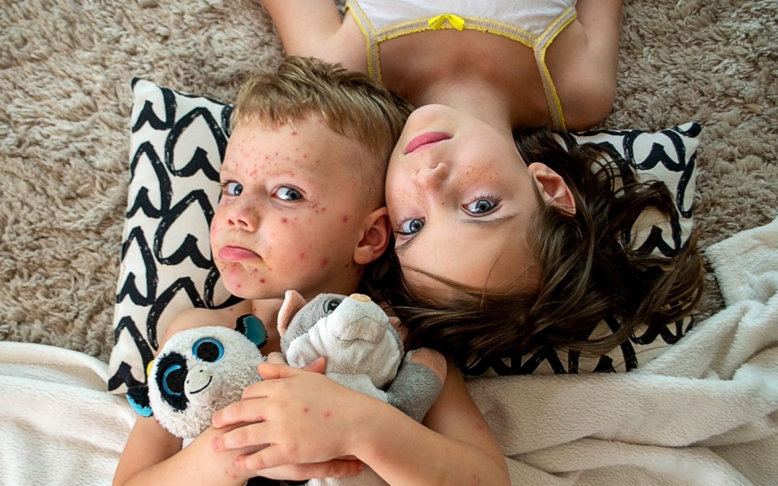 Brat in sestra z noricami – značilni izpuščaji, ki jih povzroča varicella-zoster virus.