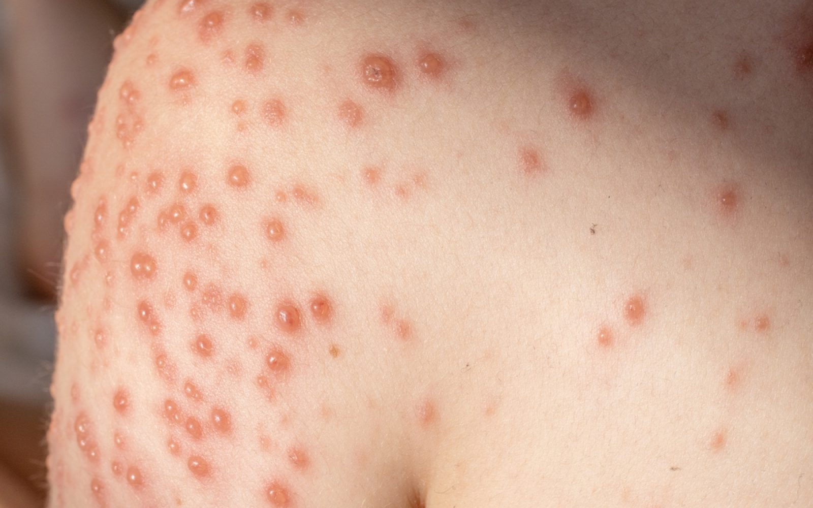 Norice. izpuščaji na koži pri otroku, značilne rdeče bunčice