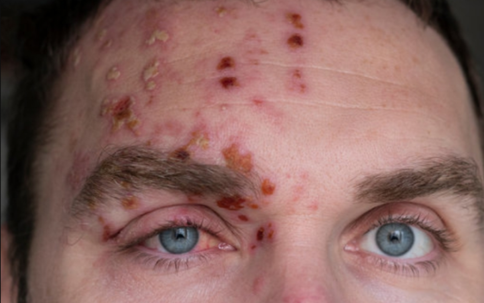 Ta na videz nedolžna bolezen lahko povzroči resne zdravstvene težave