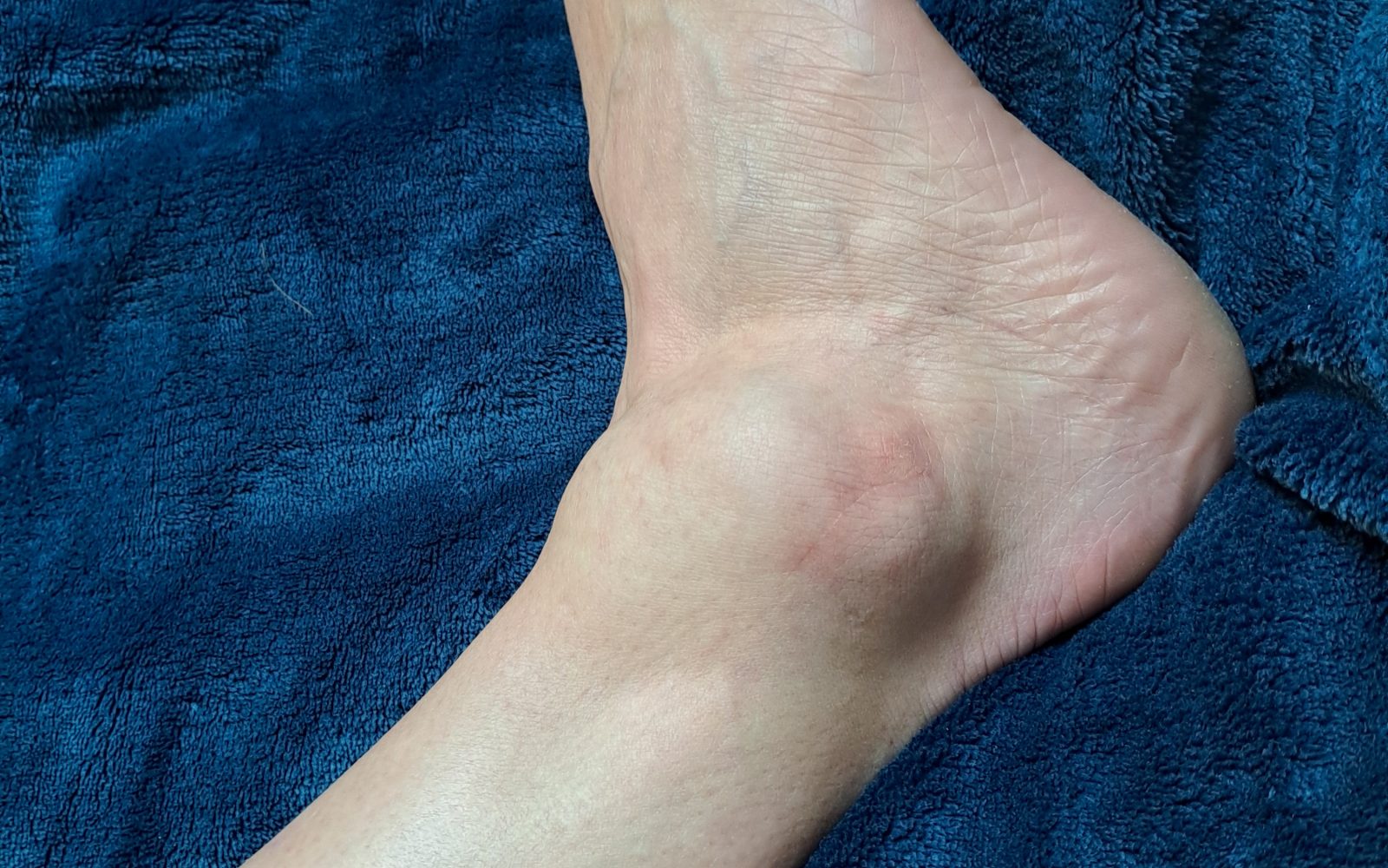 Desni gleženj takoj po zvinu