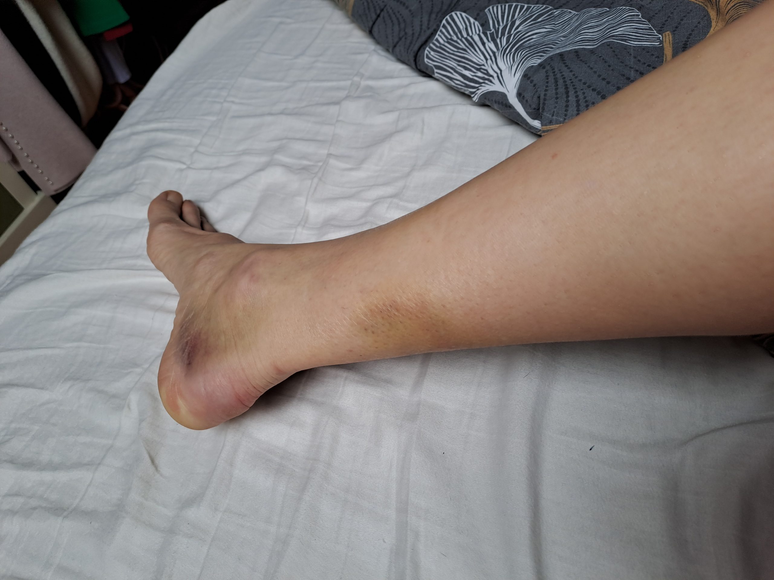 Modrice po poškodbi gležnja