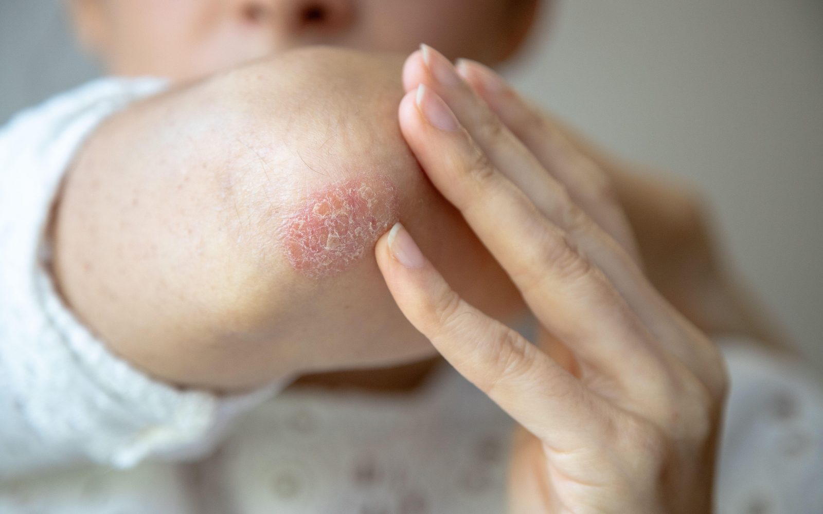 Ženska kaže žarišče luskavice (psoriaze) - plak na koži