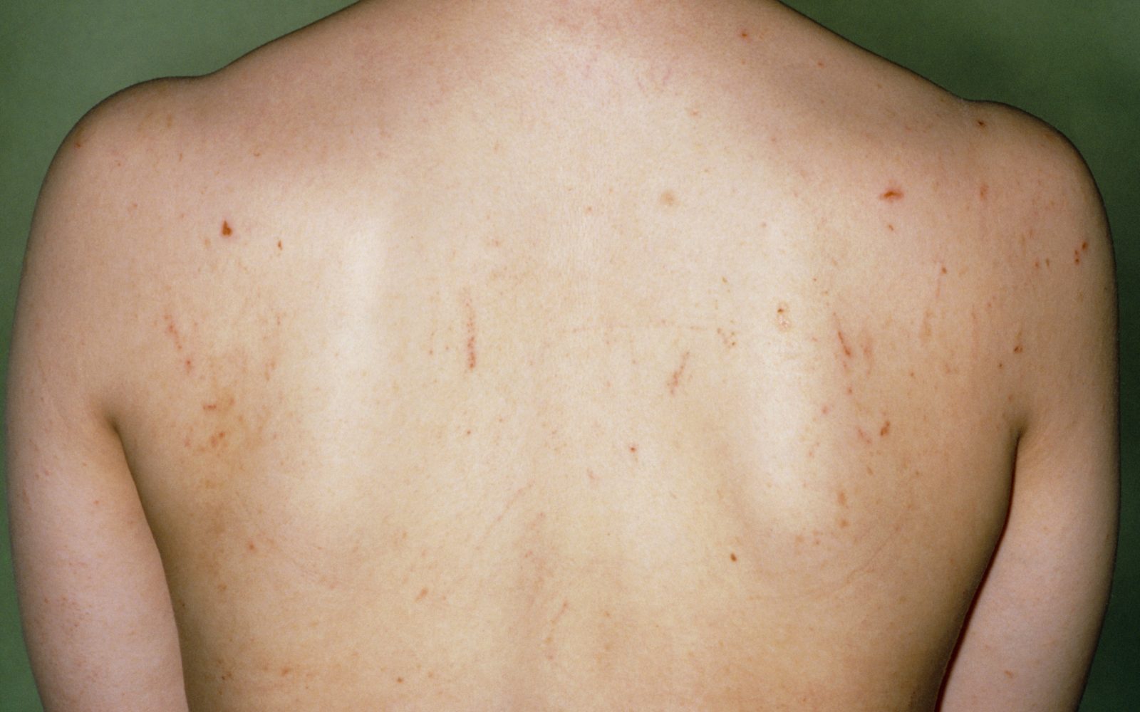 Mlada oseba z garjami