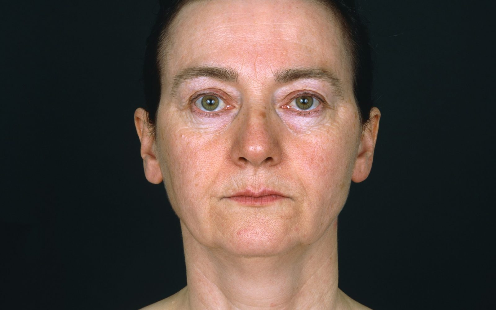 Utrujene oči, podočnjaki, povešene veke? To svetuje priznani lepotni kirurg!