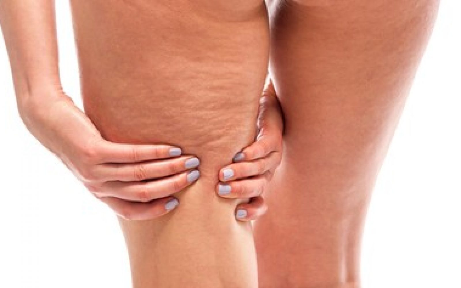 Celulit na ženskih stegnih