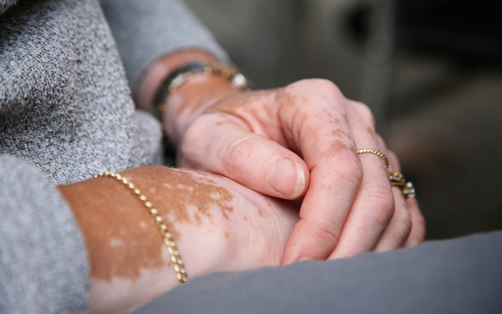 Ženska z vitiligom na rokah, kožna bolezen