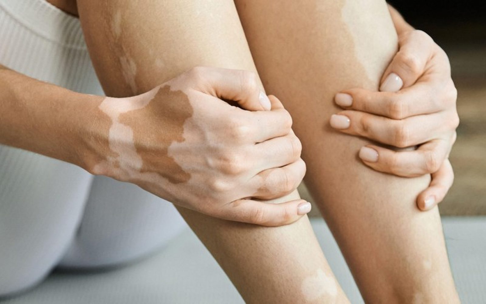 Oseba s simptomi vitiliga -depigmentirane lise na koži noge