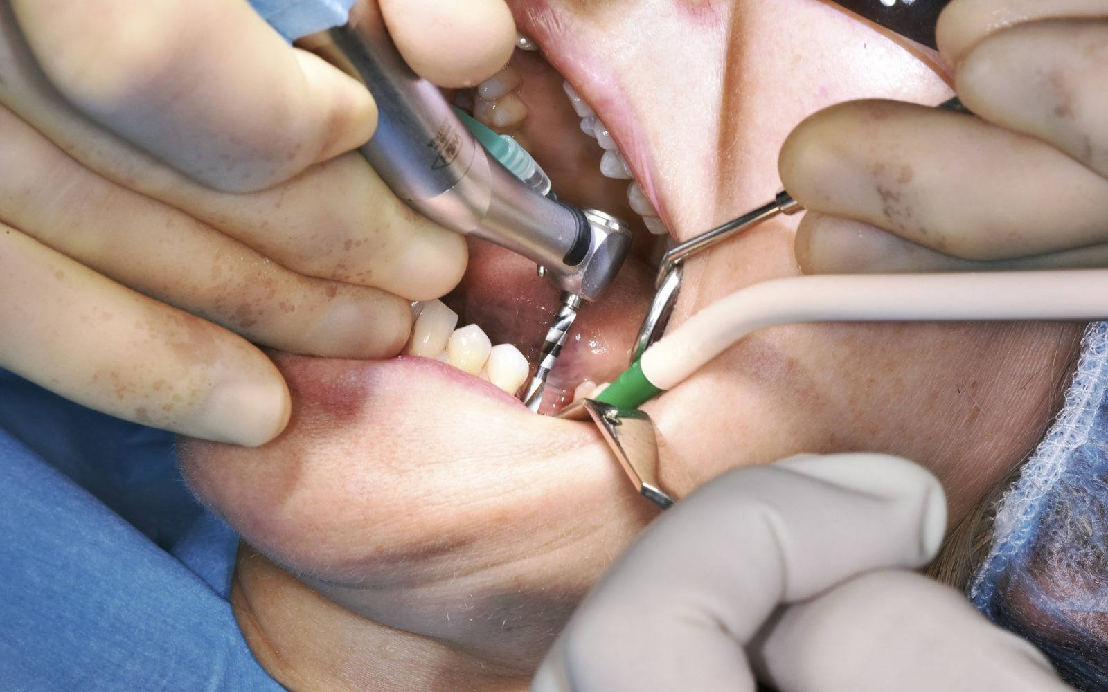 Kirurško odstranjevanje zoba