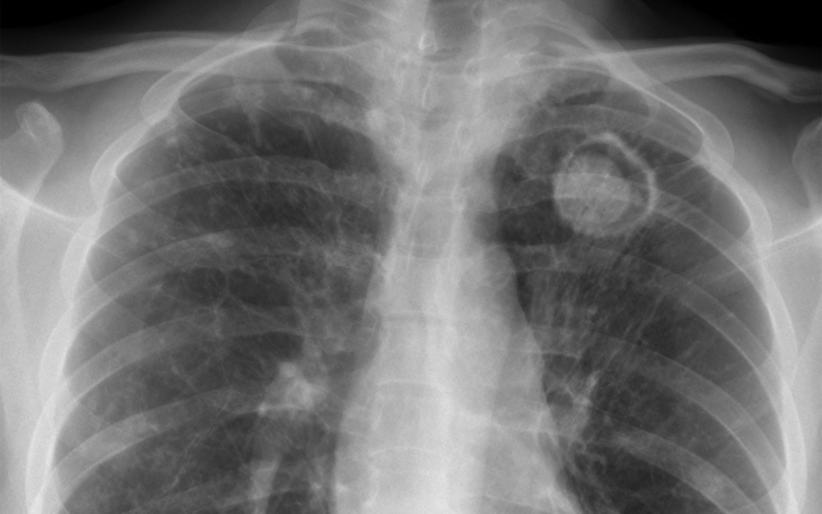 Rentgenska slika pljuč z aspergilomom – glivična okužba zaradi Aspergillus fumigatus