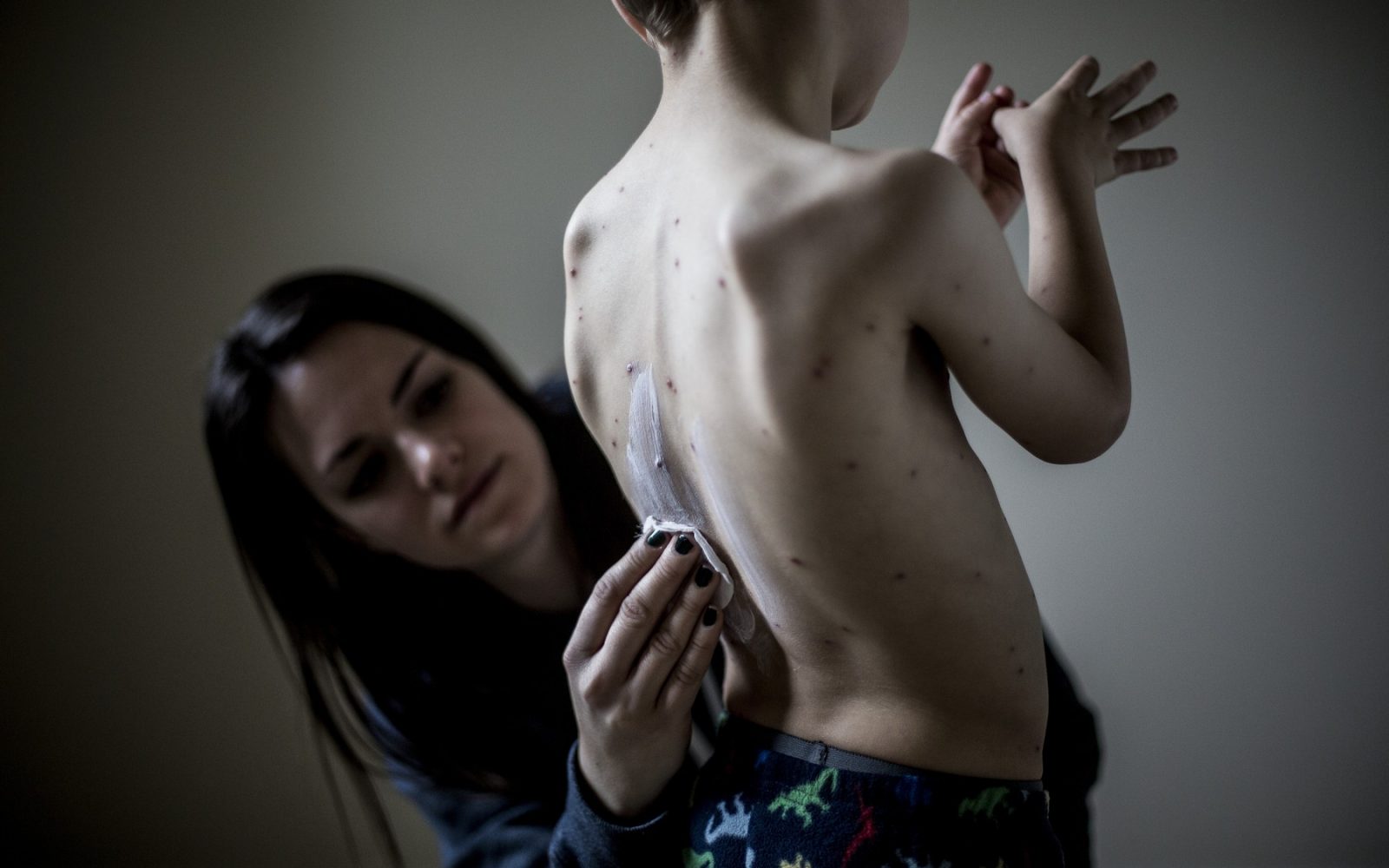 Ena otroška bolezen, tudi šest tednov bolniške? Norice lahko povsem ustavijo družino – in večina staršev tega ne ve. Odkrijte, kako jih lahko preprečite, preden se pojavijo.