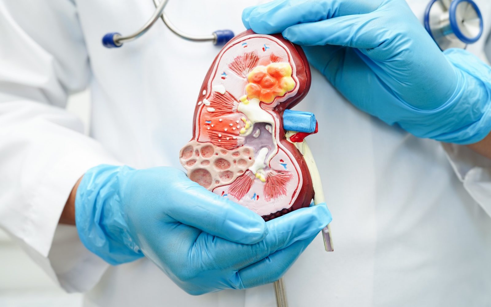 Kronična ledvična bolezen (KLB) velja za tihega morilca 21. stoletja. Kljub temu da 9 od 10 Slovencev s to boleznijo ne ve za svojo diagnozo, WHO opozarja na alarmanten trend – KLB je ena najhitreje rastočih vzrokov smrti globalno in bo do leta 2050 postala peti najpogostejši vzrok smrti.