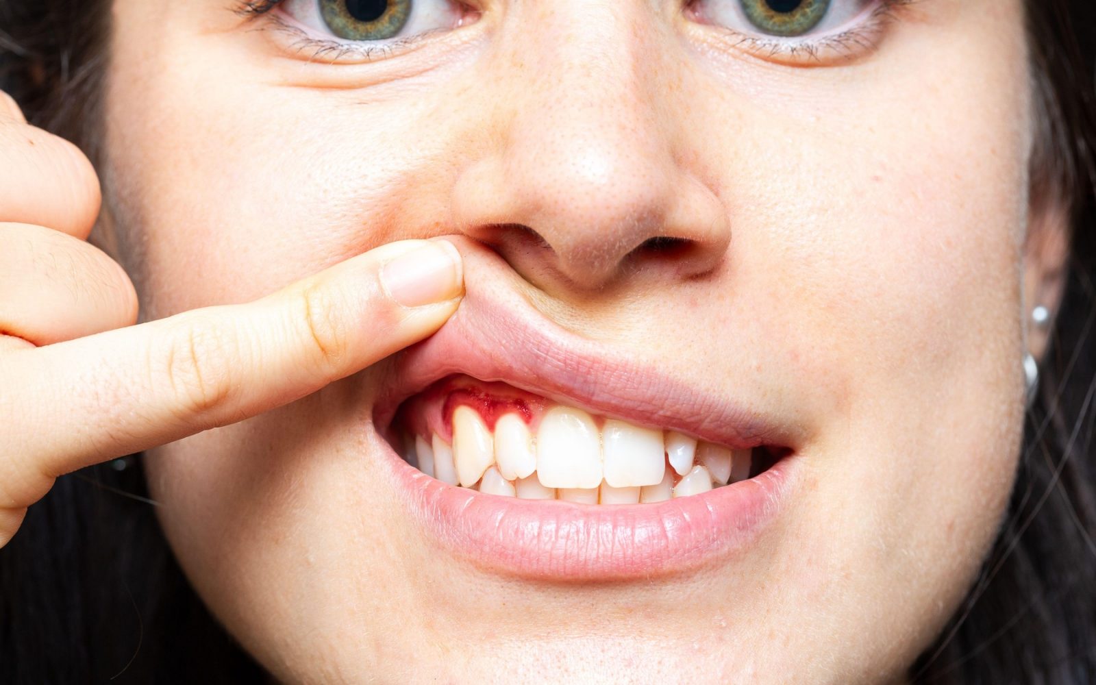 Ženska kaže krvaveče dlesni – opozorilo na težave z ustnim zdravjem, ki lahko vplivajo na srce.