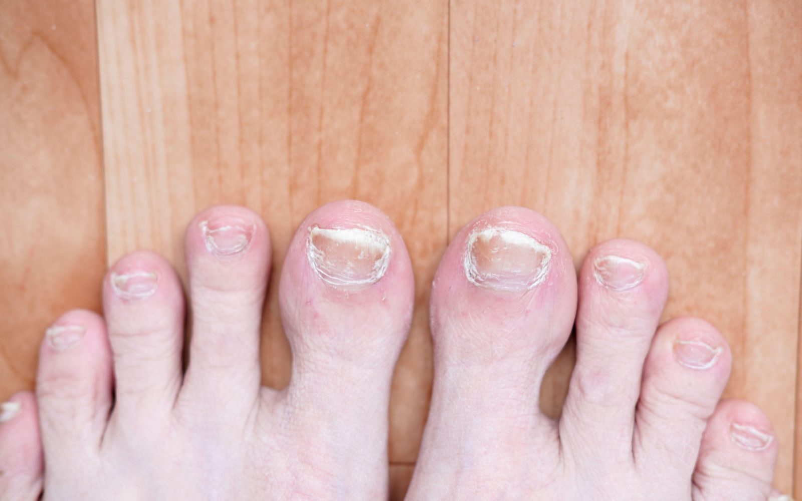 stopala, glivice, glivična okužba