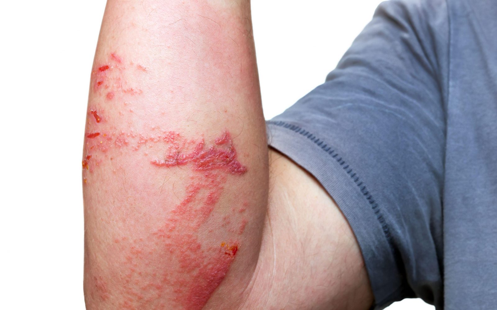 Moška roka z opeklinami, oteklino in poškodbami, ki jih je povzročil dotik meduze med plavanjem v morju.