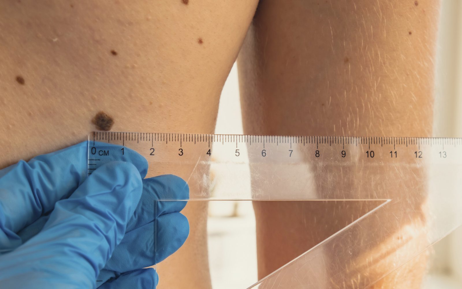 Dermatolog ocenjuje velikost znamenja.