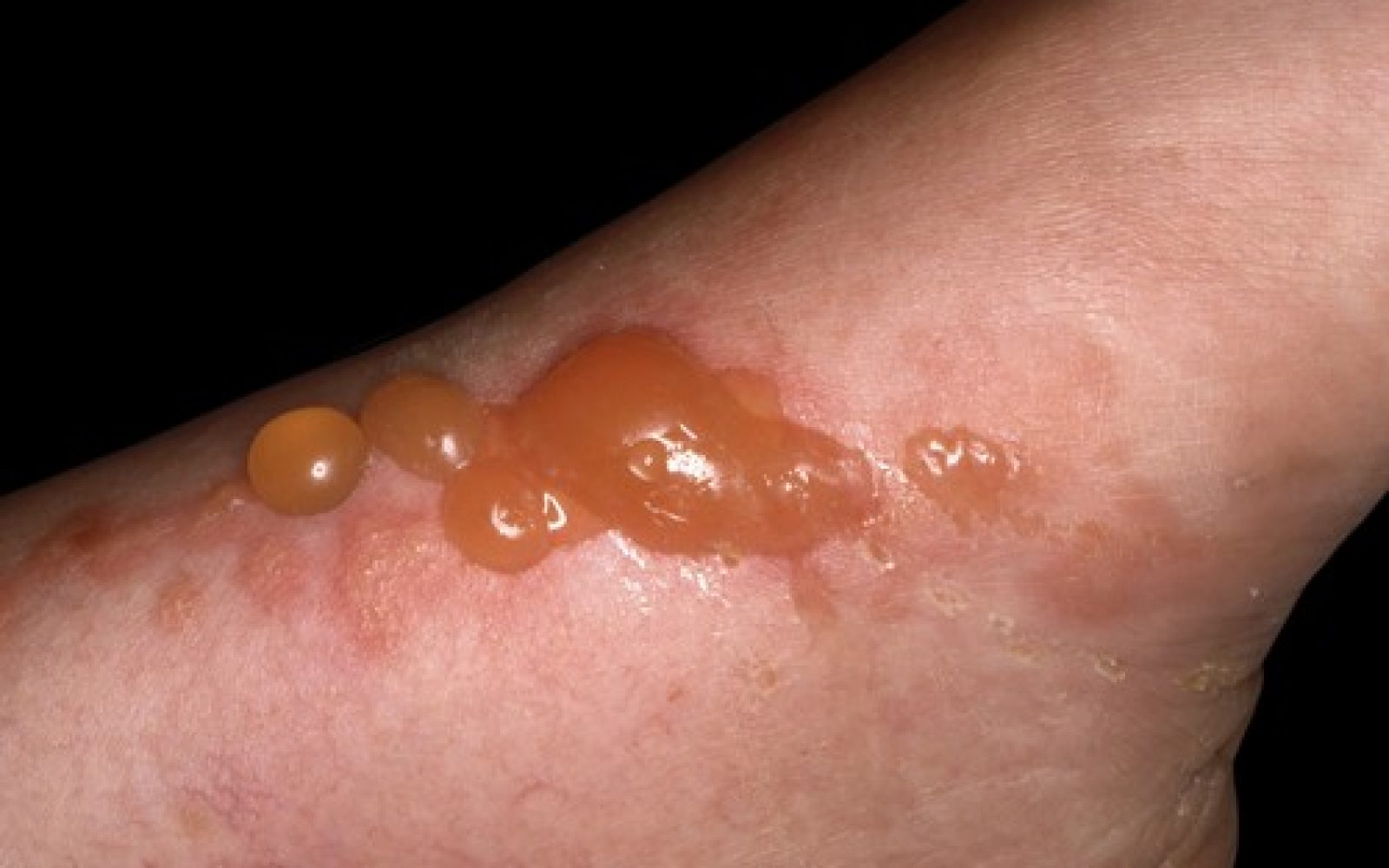 Mehurji, kot posledica fitofotodermatitisa.