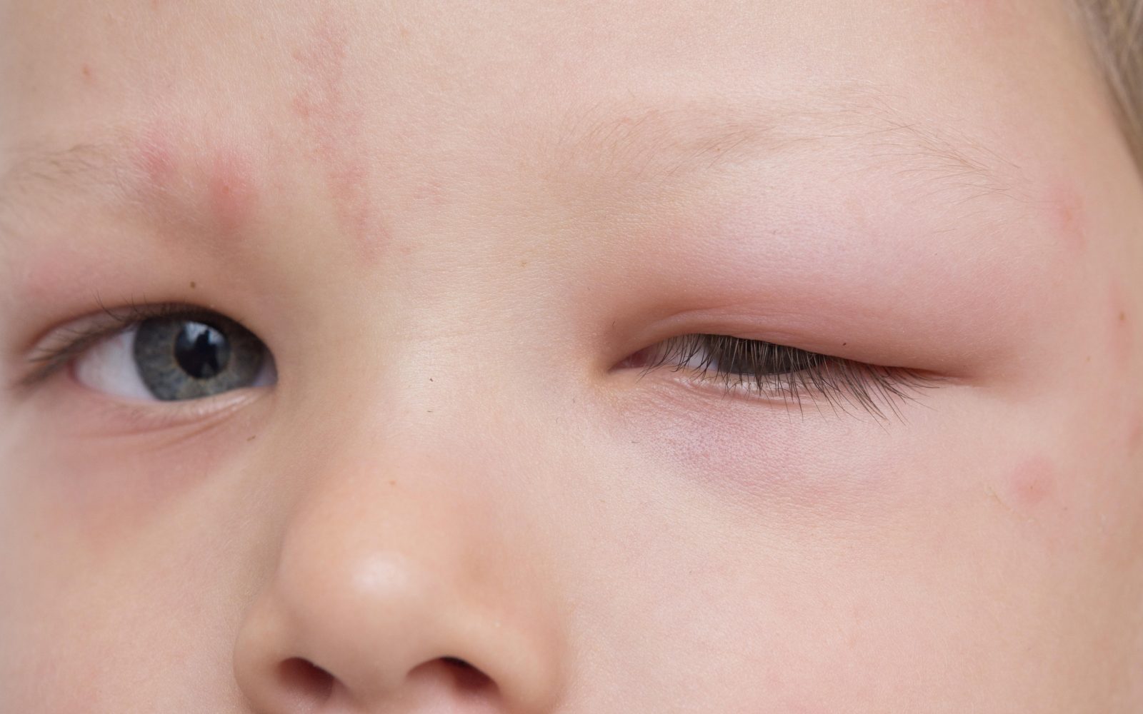 Obraz otroka, ki je otečen v obraz po piku komarja