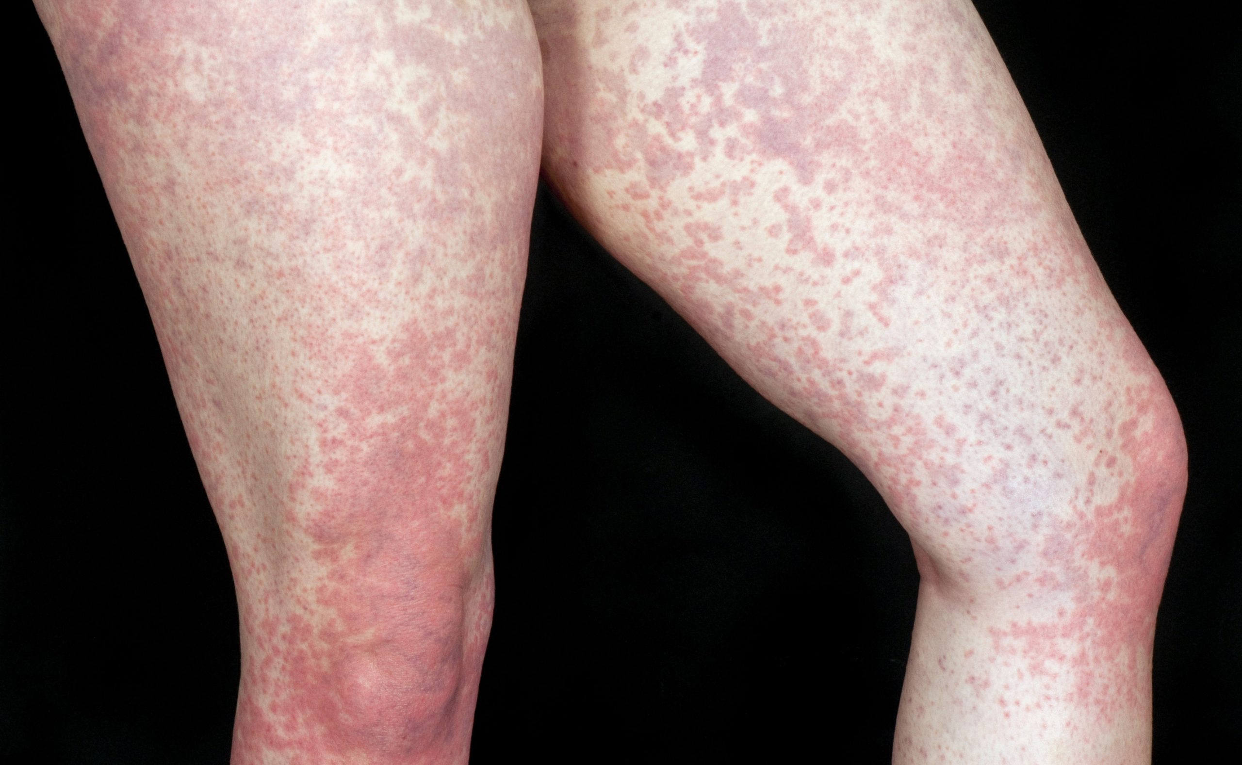 vnetje žrela pri infekcijski mononukleozi, epstein barr virus