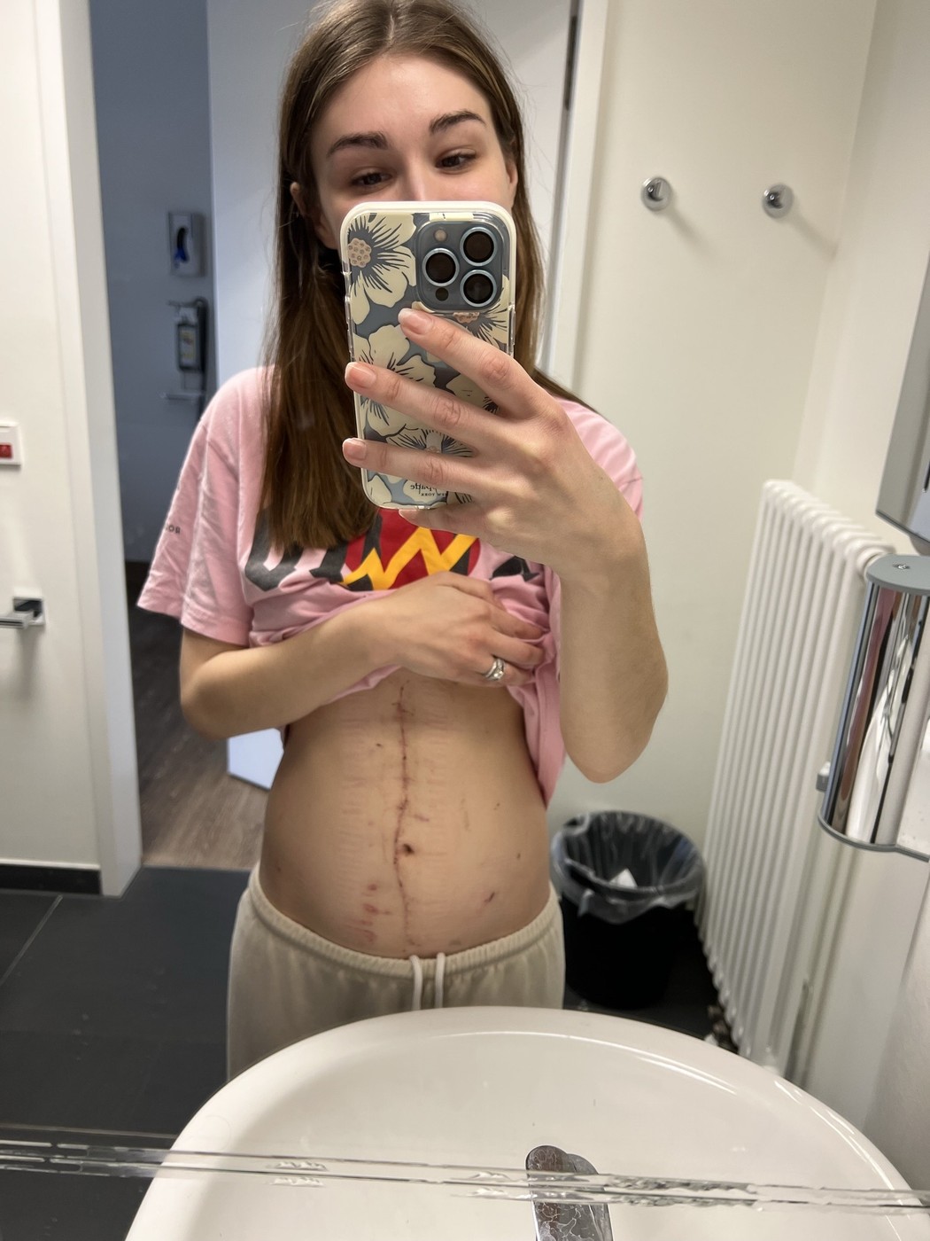 Kristina Bayus-Roszak, mlada ženska iz Ohia, je zaradi redke žilne bolezni skoraj umrla. Operacijo so ji opravili v Nemčiji, kjer so odkrili kar šest vaskularnih kompresij. Fotografija prikazuje brazgotino, ki jo je utrpela med življenjsko pomembnim posegom.  