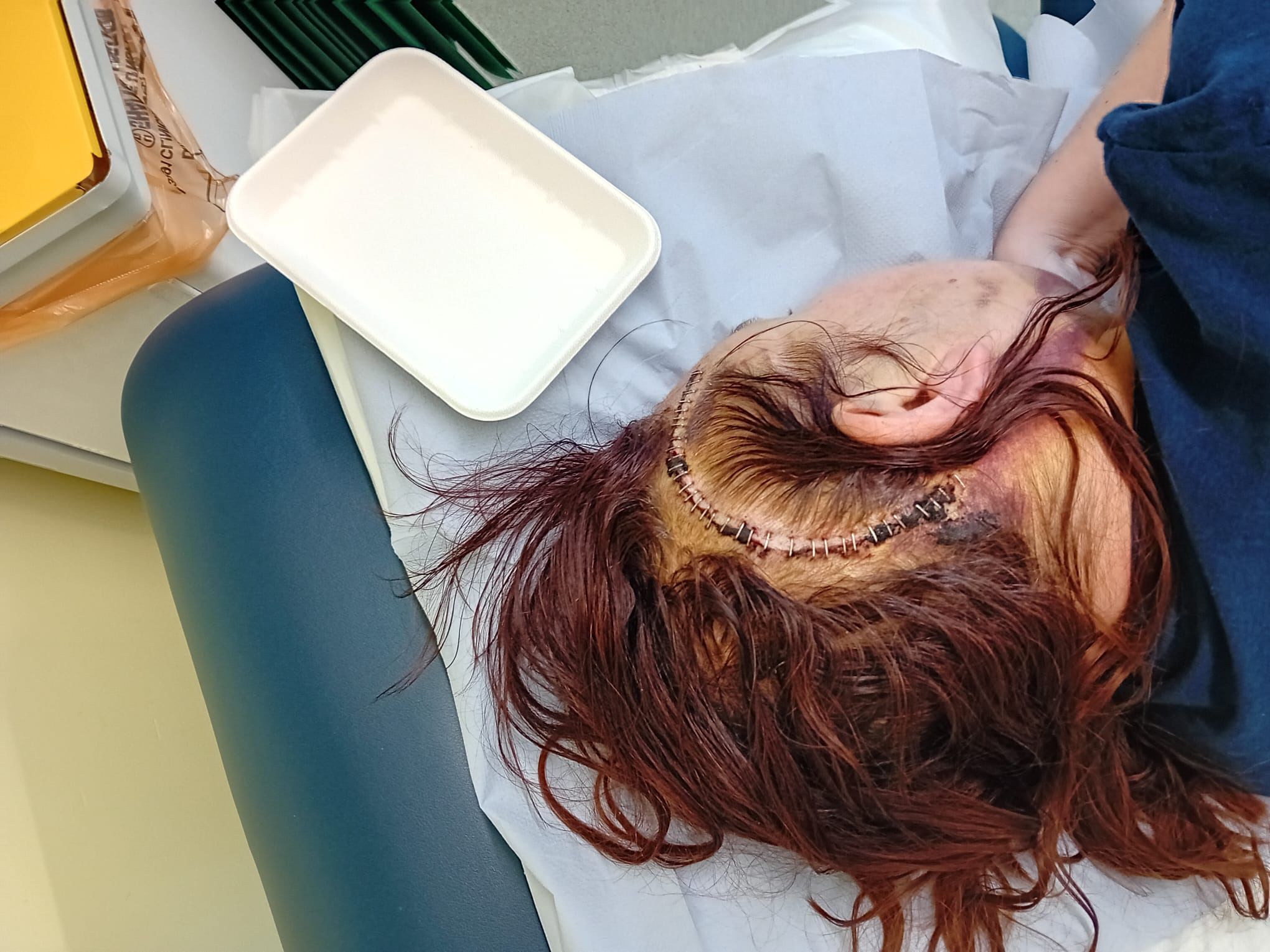 Sarah Hitchman, 43-letna učiteljica, ki je simptome možganskega tumorja sprva pripisovala perimenopavzi.