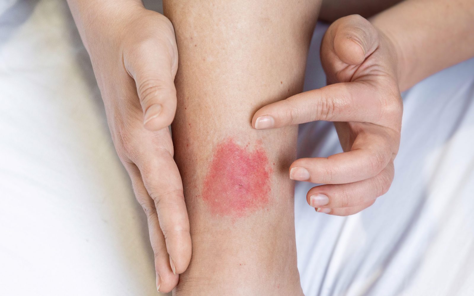 Rdeč izpuščaj na koži spodnjega dela noge kot posledica alergijske reakcije na pik žuželke.