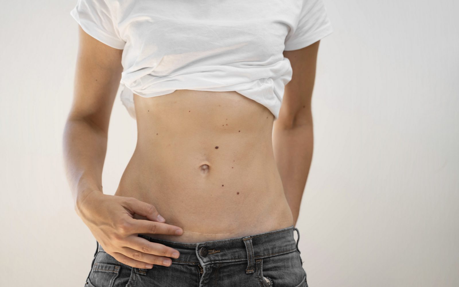 Ženska v majici in hlačah kaže brazgotino na trebuhu po carskem rezu