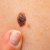 Sumljiva sprememba na koži, kožni rak, melanom