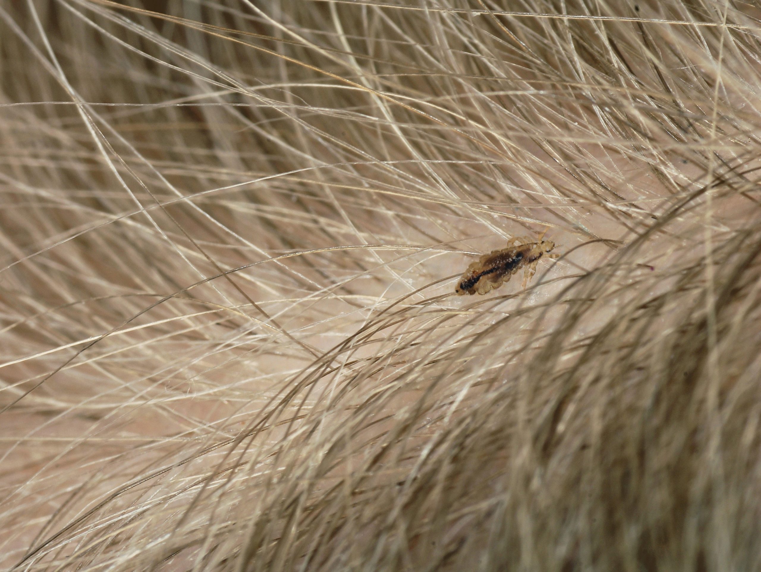 Naglavna uš v lasišču