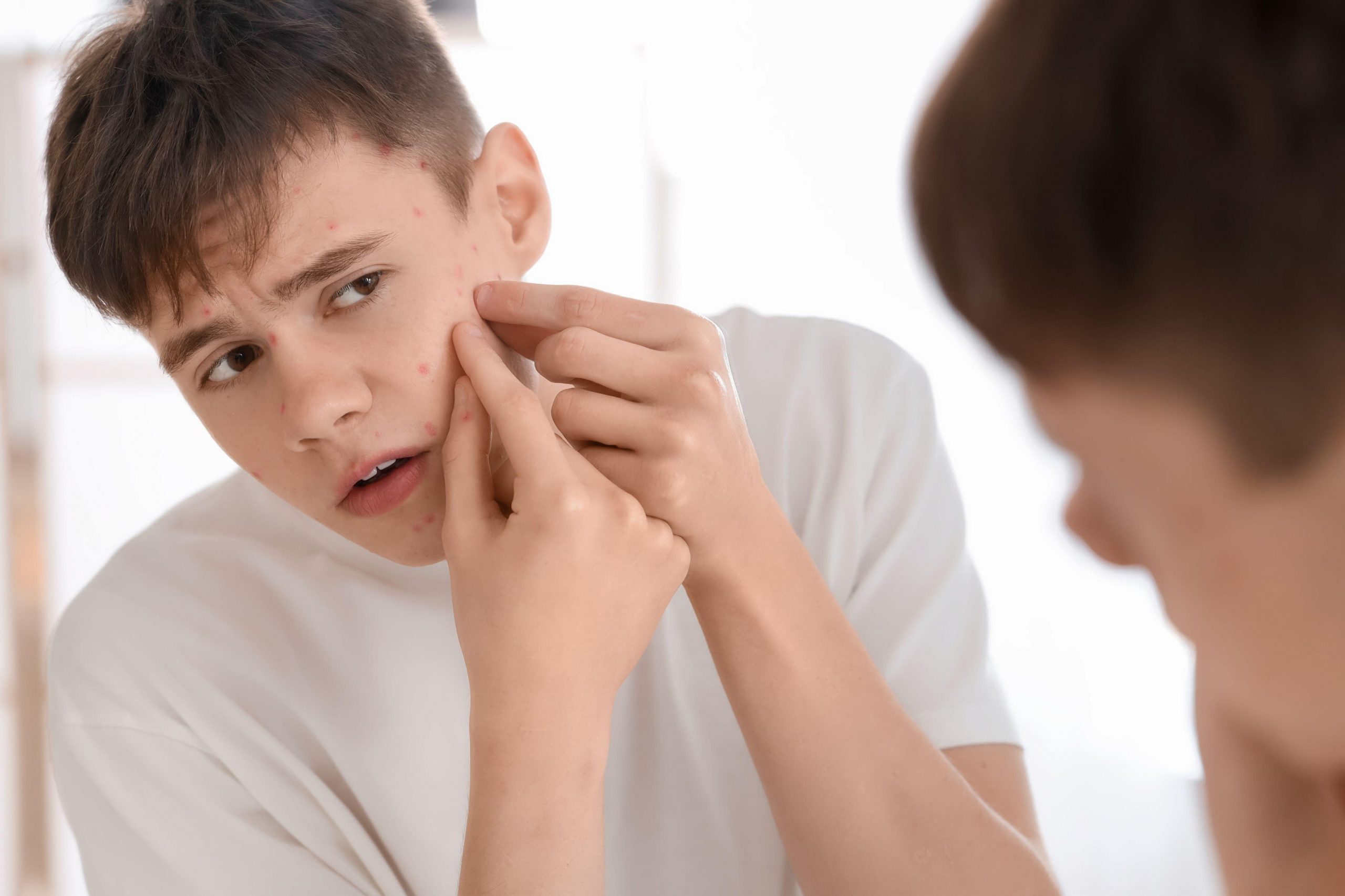 Najstnik se gleda v ogledalo in stiska mozolje - primer telesnih sprememb v obdobju odraščanja.