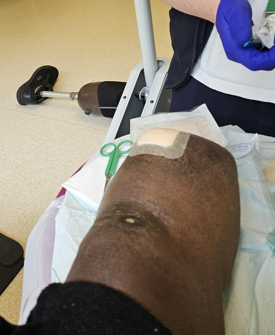 Fotografija prikazuje Olubiyija Jibowuja, 57-letnega očeta iz Londona, ki okreva po amputaciji noge zaradi zapletov po domači pedikuri. 