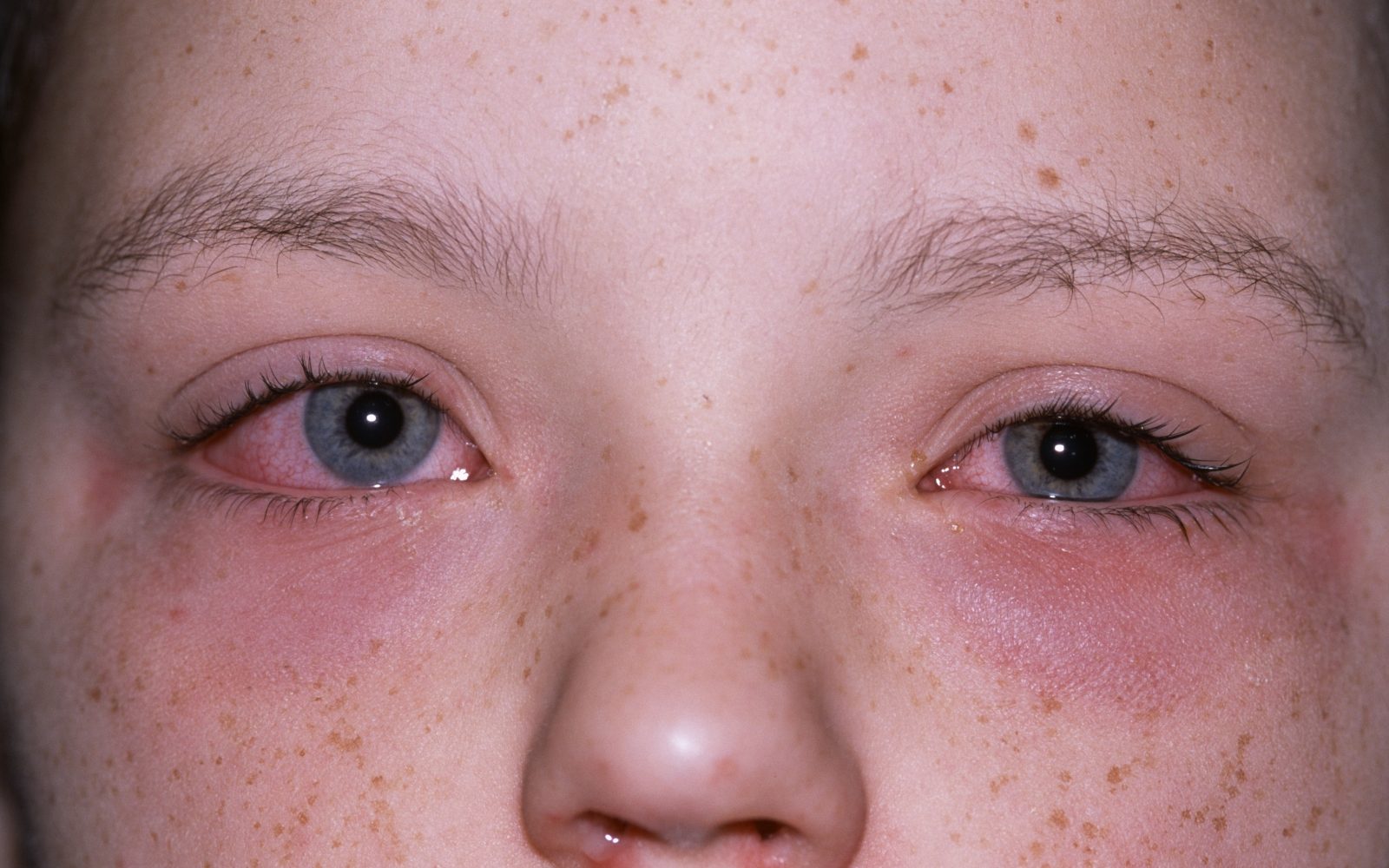 Otrok z rdečimi, solznimi in otečenimi očmi, kar kaže na alergijsko reakcijo – možen stik s cvetnim prahom ali drugimi poletnimi alergeni.