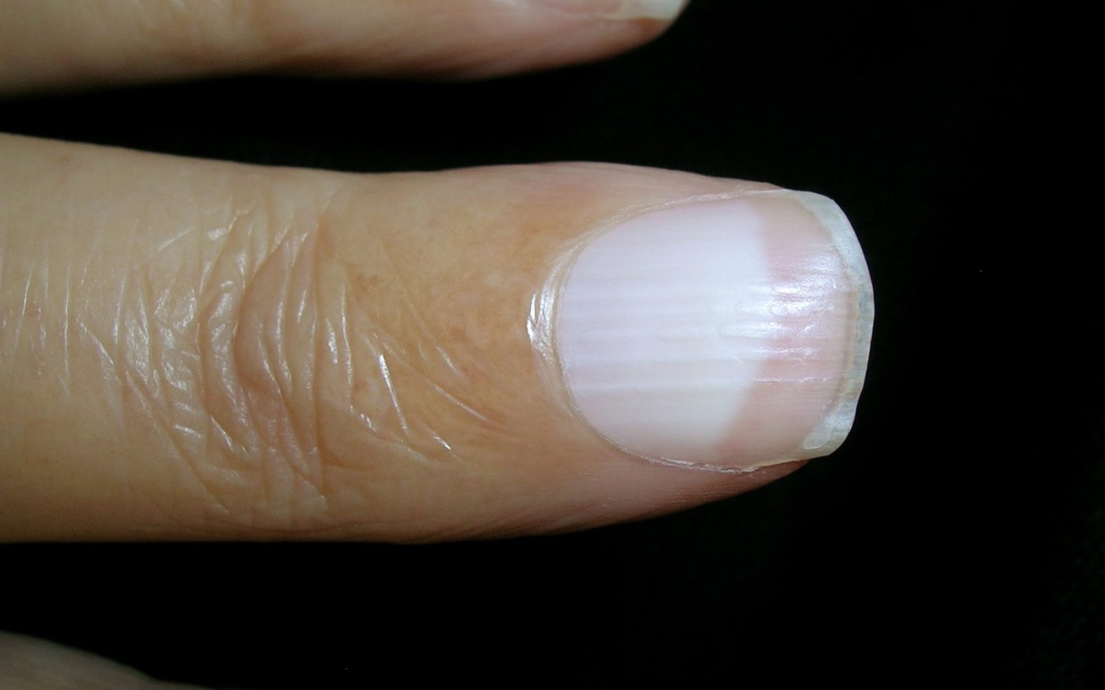 Beli nohti, znani tudi kot levkonihija, so lahko delno ali v celoti bele barve. Takšna sprememba je lahko posledica poškodbe, anemije, prehranskih pomanjkljivosti, bolezni srca ali ledvic, bolezni jeter ali celo zastrupitve. Za natančno diagnozo je priporočljiv zdravniški pregled.