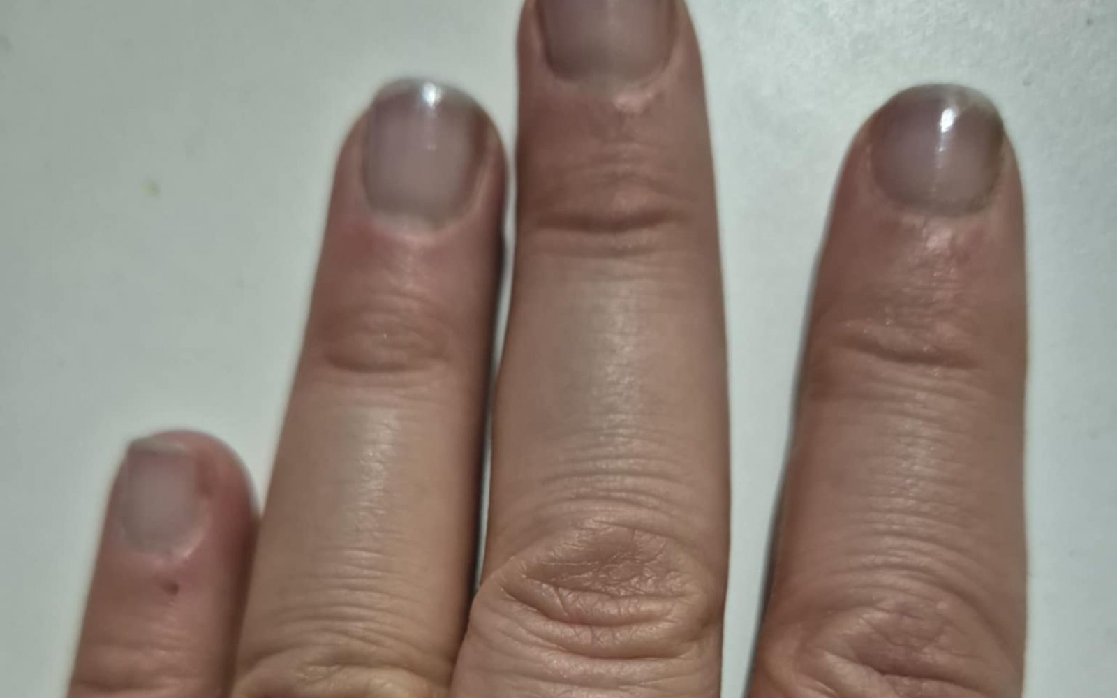 Modrikast odtenek nohtov lahko kaže na zmanjšano oksigenacijo krvi, kar se pogosto pojavi pri boleznih pljuč (npr. emfizem) ali srca. Če opazite to spremembo skupaj z drugimi simptomi, kot so težko dihanje, bolečina v prsih ali utrujenost, je priporočljiv takojšen zdravniški pregled.