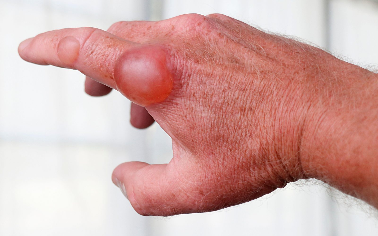 Moška roka, ki ima na kazalcu dva velika mehurja, ki sta nastala zaradi opekline z vročo paro.